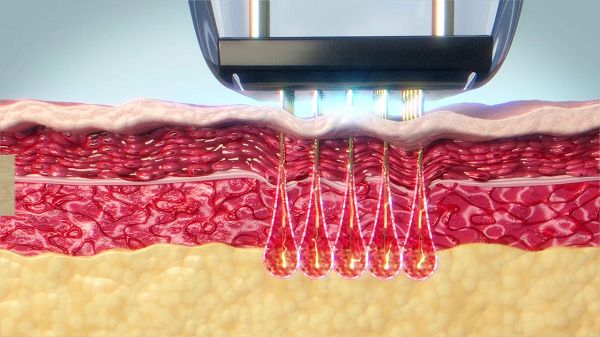 What Is RF Microneedling What Is RF Microneedling